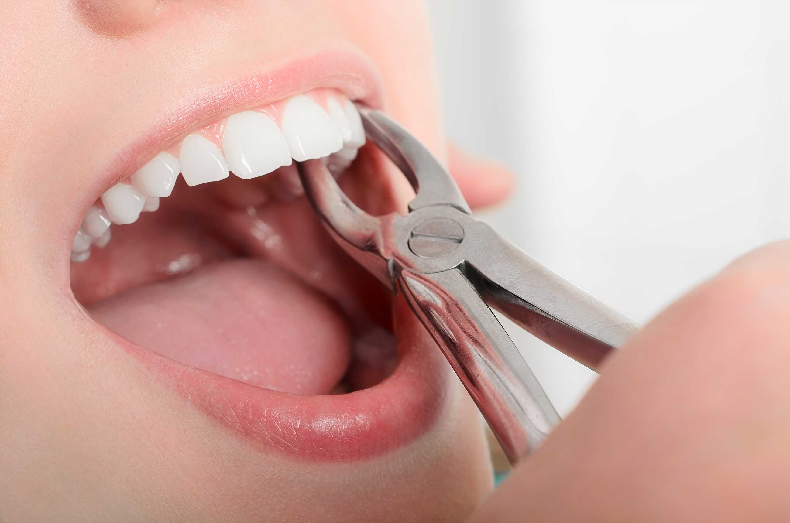 Painless Tooth Extraction Service Bangalore